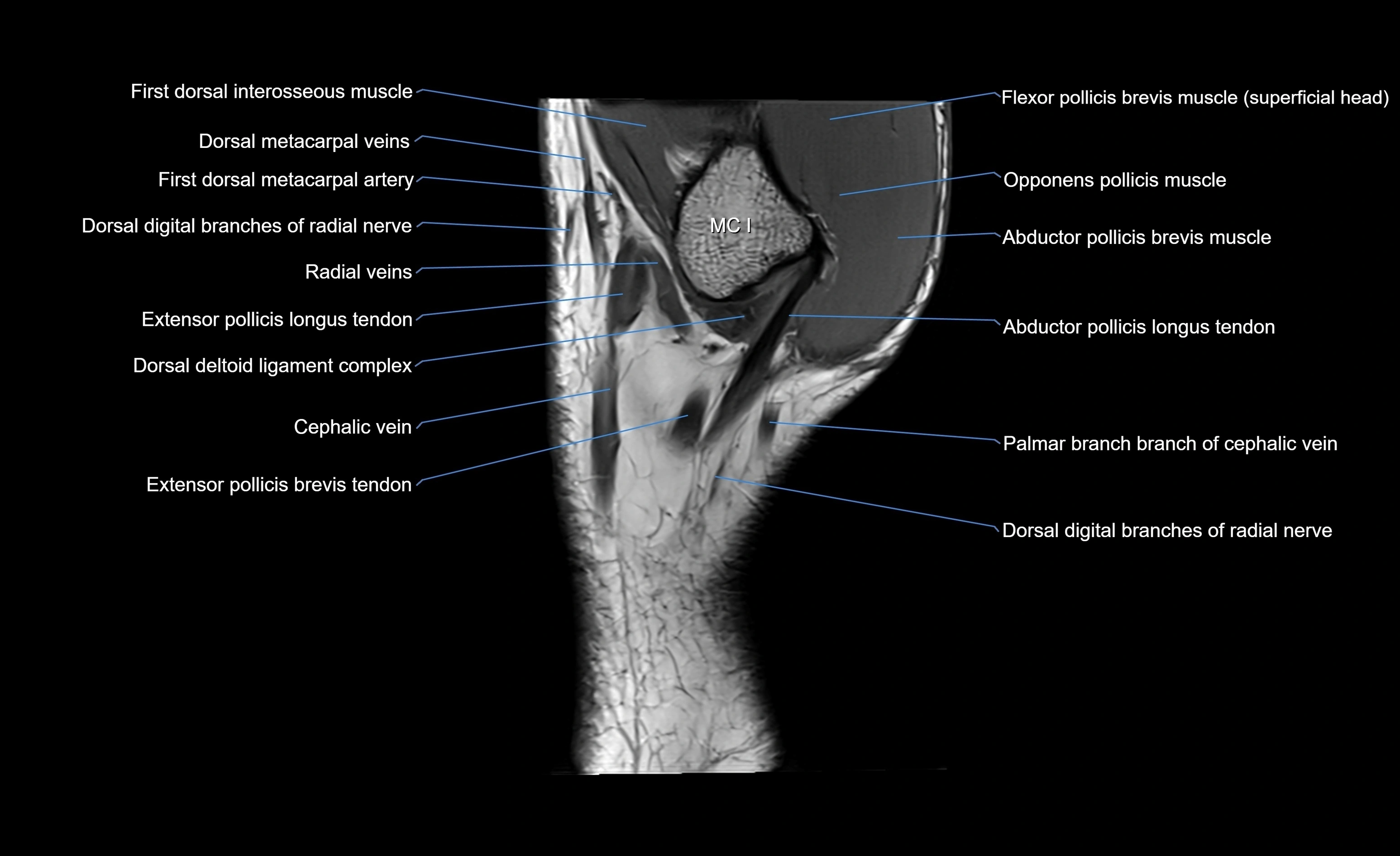 MRI wrist sagittal cross sectional anatomy 3T  radiology  image-img-00001-00002.webp